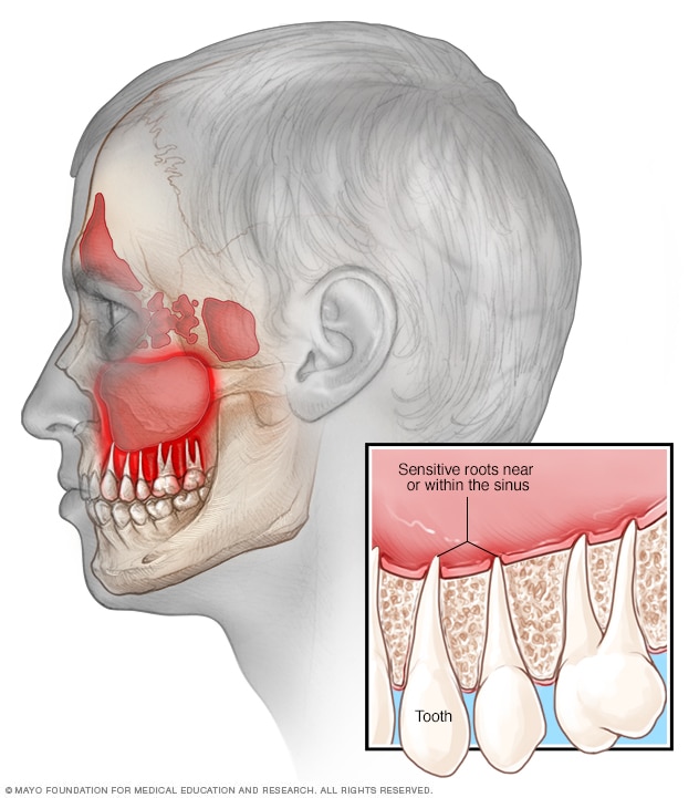 Ilustración que muestra cómo la sinusitis puede causar dolor de muelas