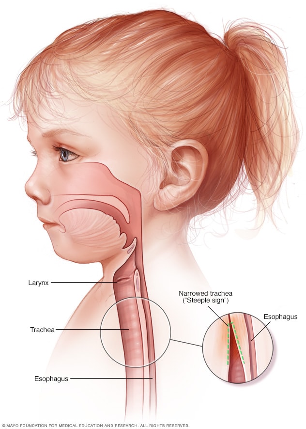 Un niño con crup