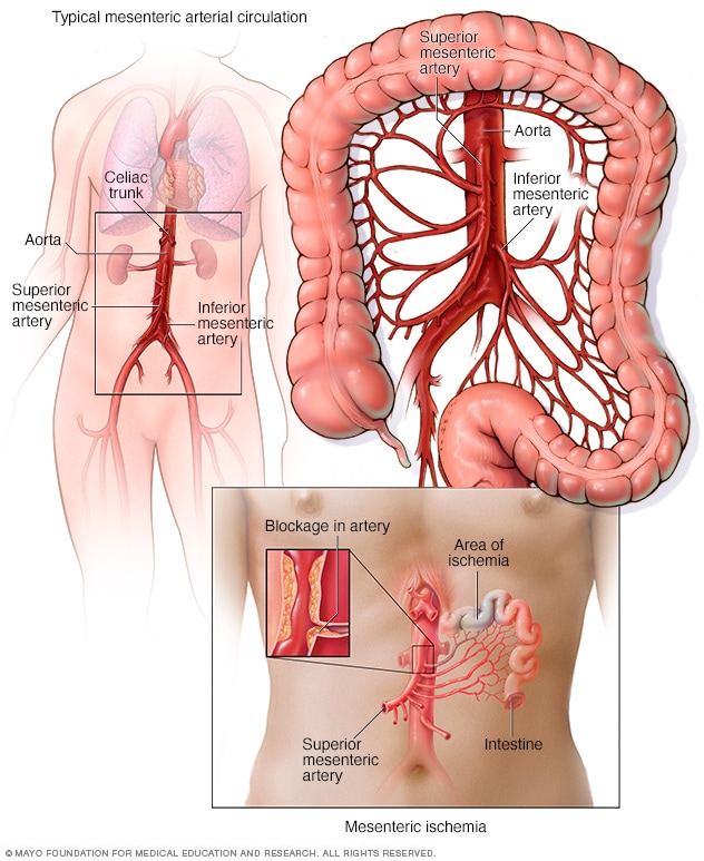 Typical mesenteric arterial circulation and mesenteric ischemia