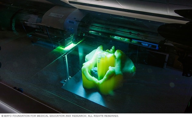 Una impresora 3D en mitad del proceso de producción del modelo de la pelvis de un paciente