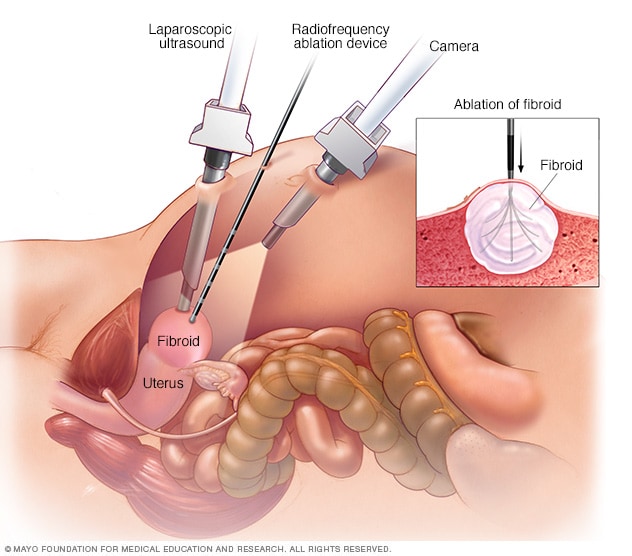Laparoscopic radiofrequency ablation for treating uterine fibroids