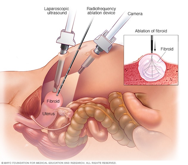 https://www.mayoclinic.org/-/media/kcms/gbs/patient-consumer/images/2019/11/13/14/26/_lap-rfa-for-uterine-fibroids-8col-3893521-001-0.jpg?utm_source=chatgpt.com