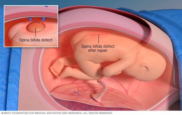 Fetoscopic surgery on fetus
