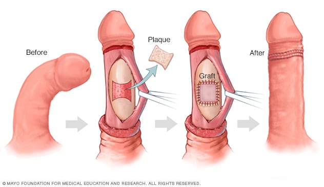 移植修复阴茎，以矫正弯曲或其他畸形缺陷