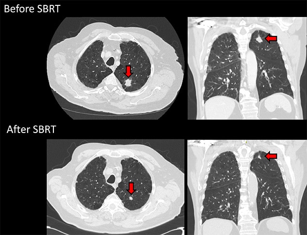 立体定向放疗在治疗肺癌方面显示出有效迹象