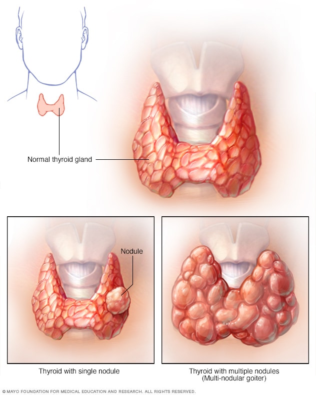 Thyroid nodules - Mayo Clinic