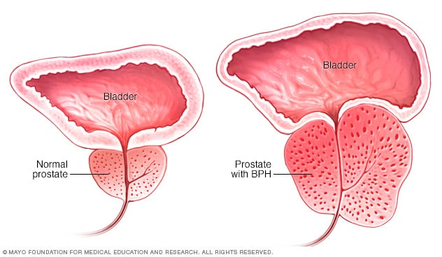 Enlarged prostate with benign prostatic hyperplasia compared with normal prostate