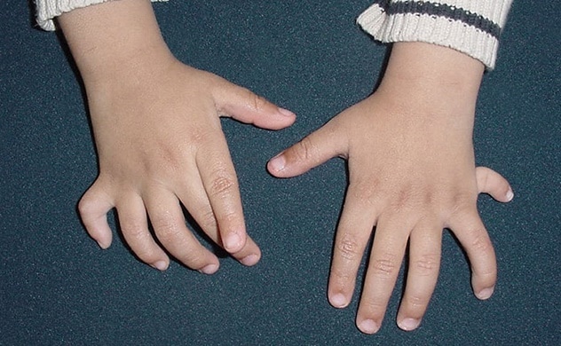 Las manos de un niño, con dedos adicionales (polidactilia), una afección congénita