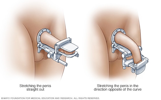 Peyronie's Disease Overview, Symptoms, Diagnosis & Treatment Options