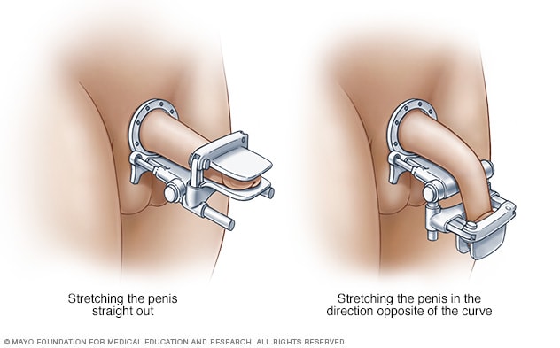 Peyronie's Disease: Causes, Symptoms, Diagnosis & Treatment