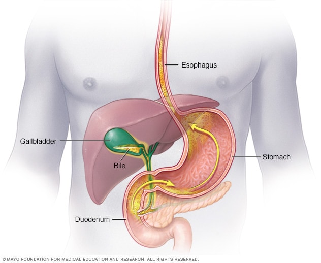胆汁反流到胃部和食管