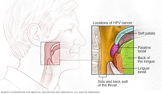 Throat cancer benign tumor, Papilloma benign tumor