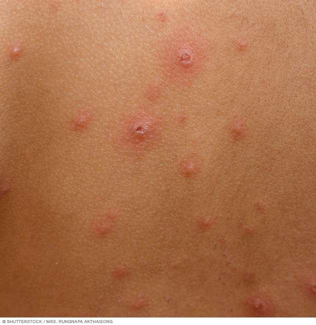 Early signs of chickenpox