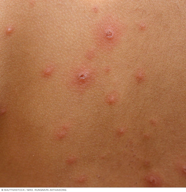 chicken pox pictures in adults