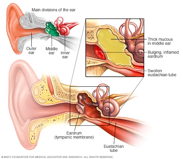 Symptoms of Ear Infections