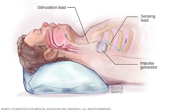 Un sistema de estimulación de las vías respiratorias