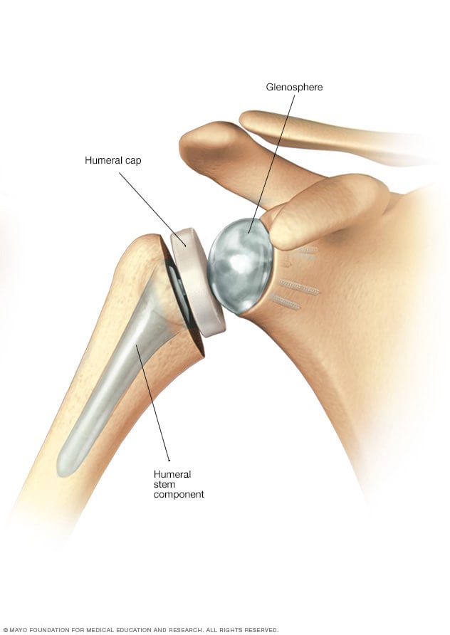 shoulder replacement