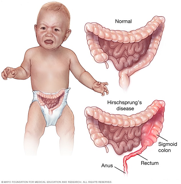 Ilustración que muestra colon y recto normales y con enfermedad de Hirschsprung