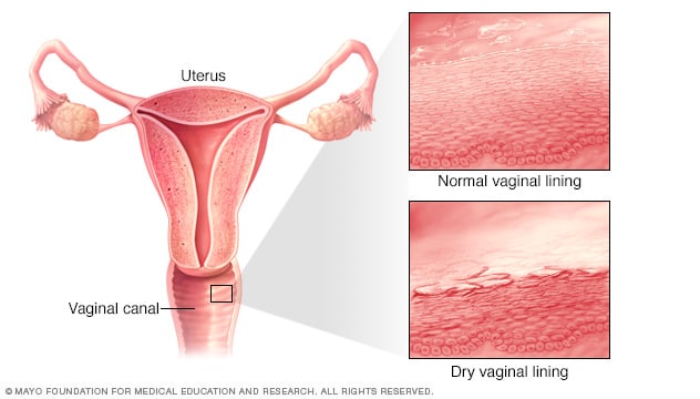 Normal vaginal lining vs. dry vaginal lining