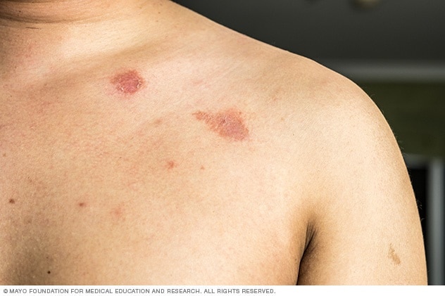 Ringworm on a shoulder - Mayo Clinic