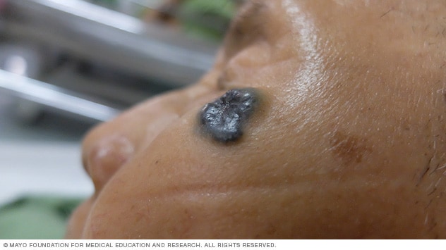 Basal cell carcinoma on brown skin