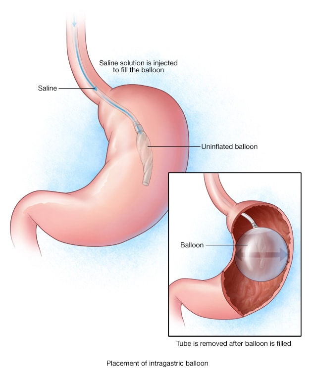 The intragastric balloon procedure