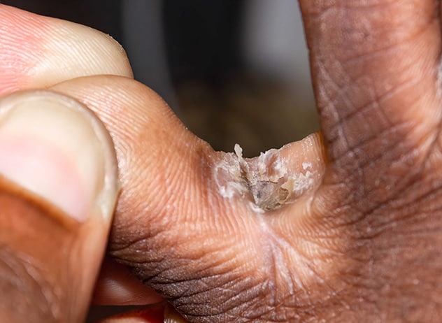 Scaly rash between the toes