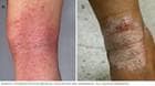 يظهر التهاب الجلد التأتبي غالبًا بين ثنيات الجلد.