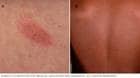 Pityriasis rosea might start with a herald patch, which disappears. Soon after, a spreading rash develops in a branchlike pattern.