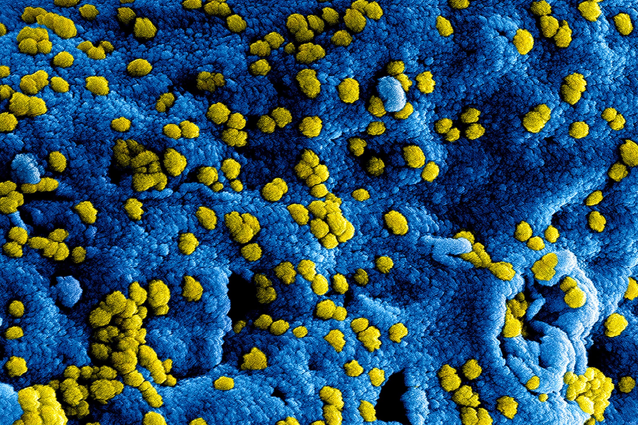 Coronavirus del síndrome respiratorio agudo grave