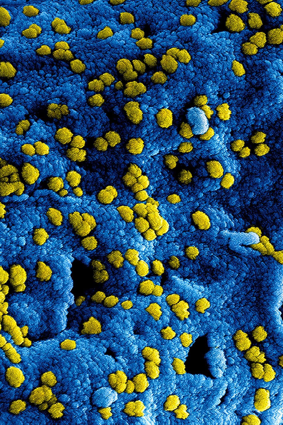 Coronavirus del síndrome respiratorio agudo grave (SARS-CoV)