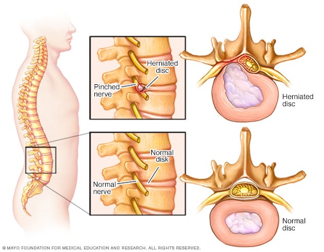 makeup kamera embargo Pinched nerve - Symptoms and causes - Mayo Clinic