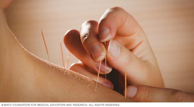 Person getting acupuncture treatment in therapy room.