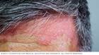 Imagen de psoriasis del cuero cabelludo