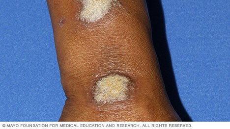 Image of plaque psoriasis