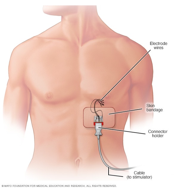 Illustration showing the pieces of a diaphragm pacing system