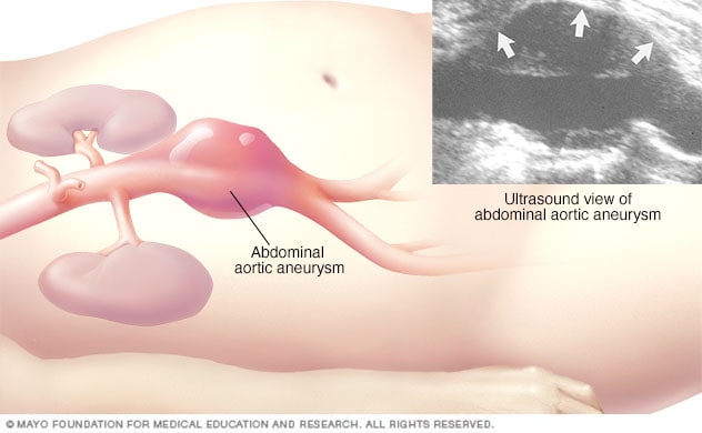 Ecografía abdominal de un aneurisma aórtico abdominal