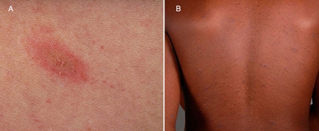 Pityriasis rosea might start with a herald patch, which disappears. Soon after, a spreading rash develops in a branchlike pattern.