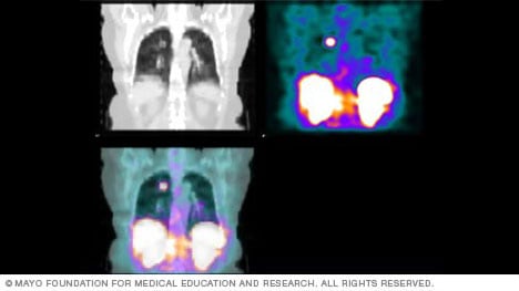 SPECT scan results picture