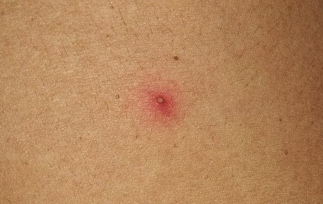 Pústulas de una foliculitis