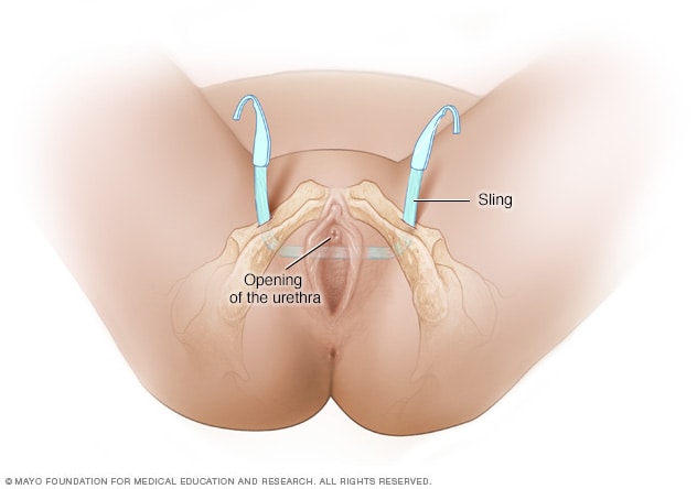 Sling placement in a transobturator sling procedure