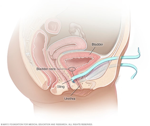 Sling placement in a retropubic sling procedure