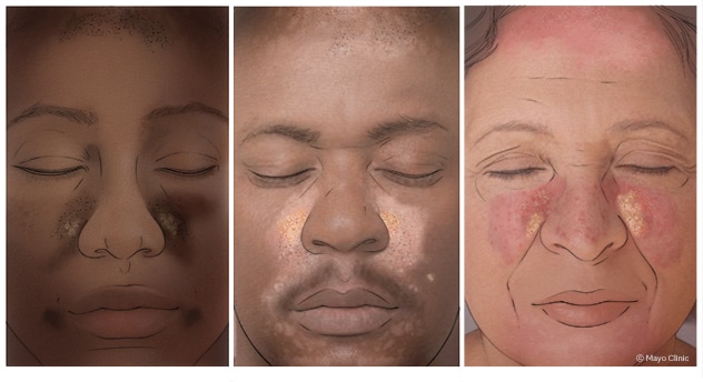 79 fotos e imágenes de Dermatitis Seborreica - Getty Images