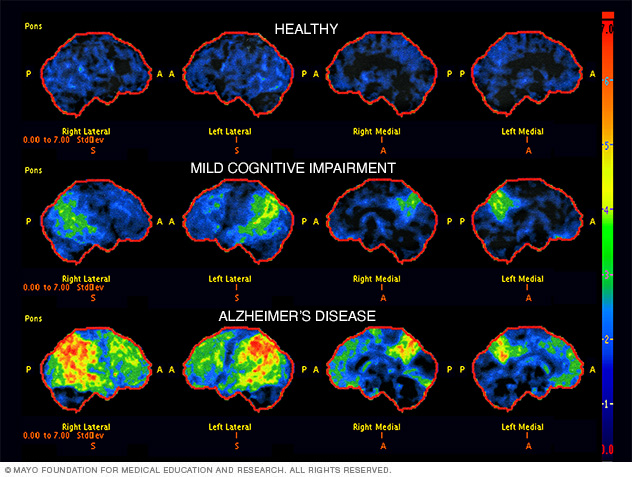 Brain scans used in the diagnosis of Alzheimer's disease.