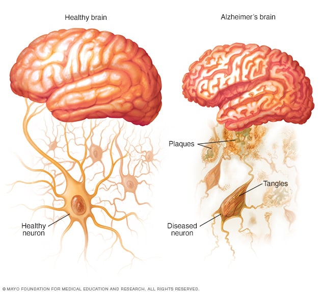 Amyloid plaques and neurofibrillary tangles in the brain