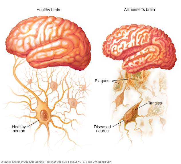 Cerebro Sano Y Cerebro Con La Enfermedad De Alzheimer Mayo Clinic Cerebro Sano Y Cerebro Con La Enfermedad De Alzheimer Mayo Clinic