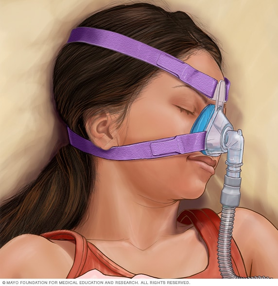 Niña durmiendo con presión positiva continua sobre las vías respiratorias