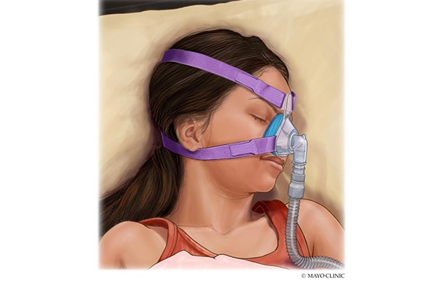 A girl sleeping with continuous positive airway pressure (CPAP)