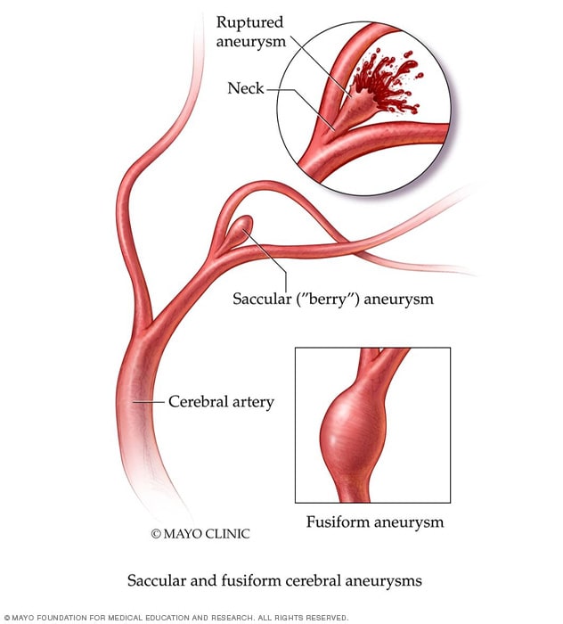 aneurysms