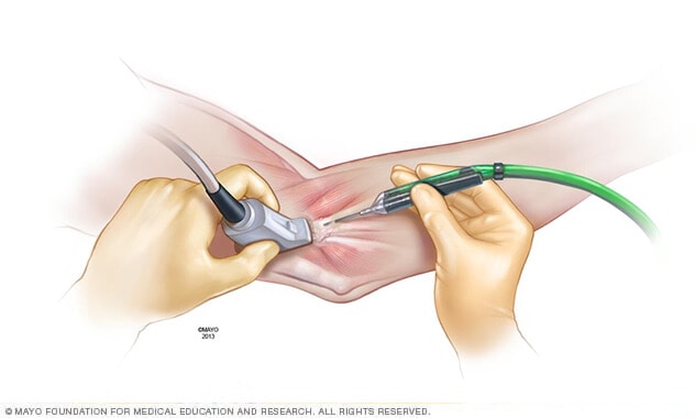 Fascia and surgical tenotomy